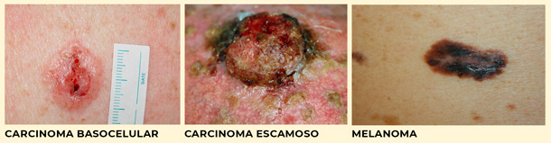 Cáncer de piel, ejemplos