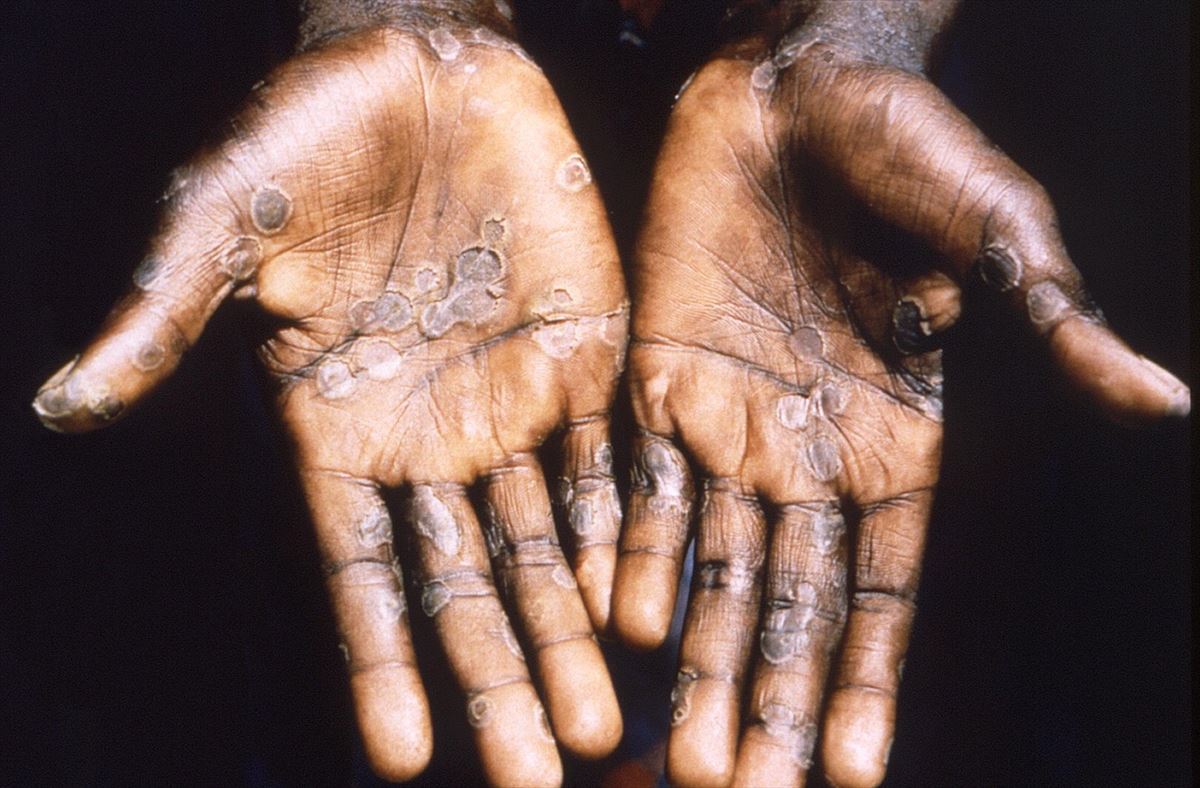 Las lesiones provocadas en la piel por la viruela del mono. Foto de archivo: EFE