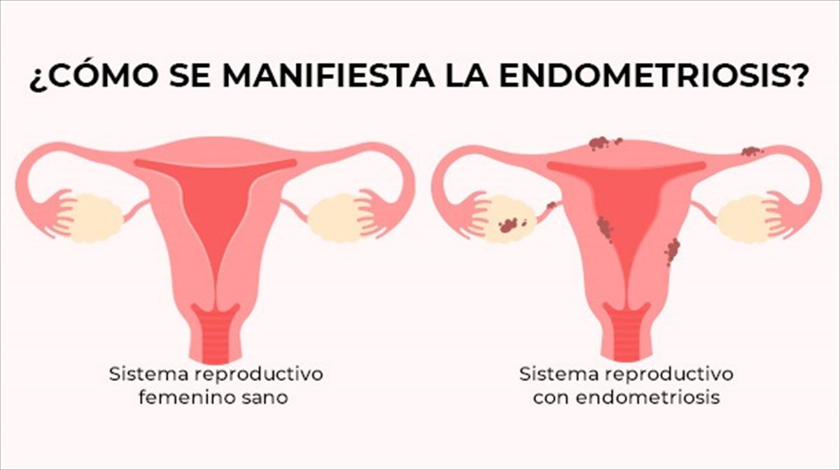 Endometriosis ¿qué Es ¿cómo Afecta A Ese 12 De Mujeres Que La Sufre Testimonios De Dos 0358